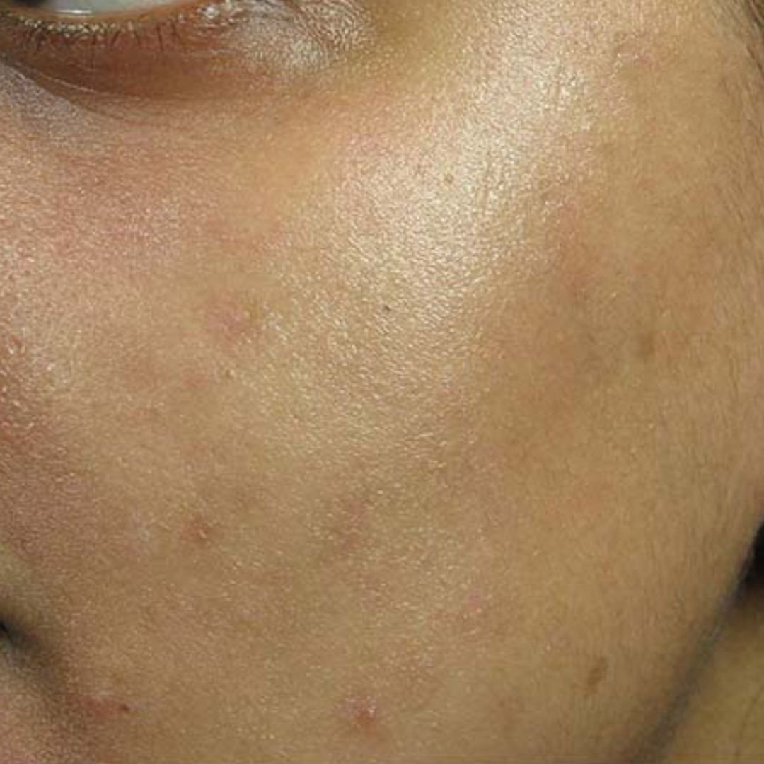 acne scar treatment after