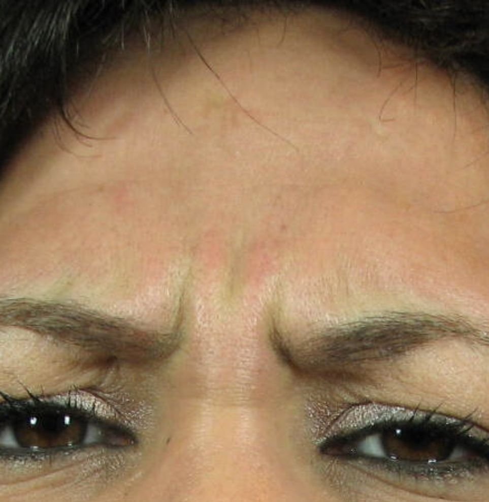 frown lines botox before
