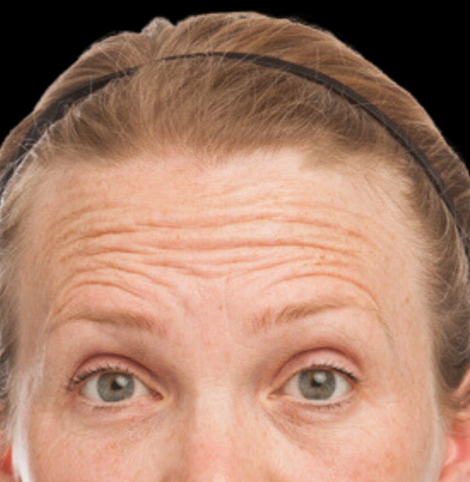 forehead lines botox treatment before
