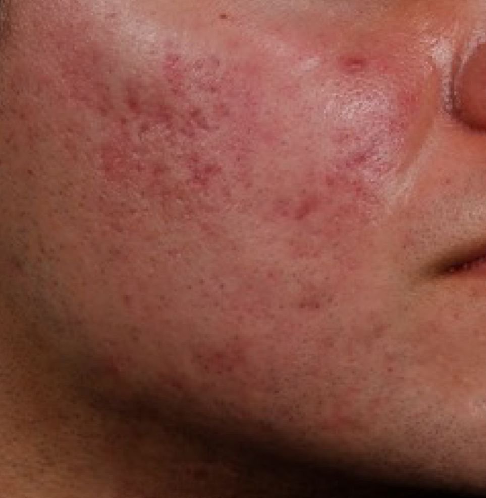acne london 6 to 12 before