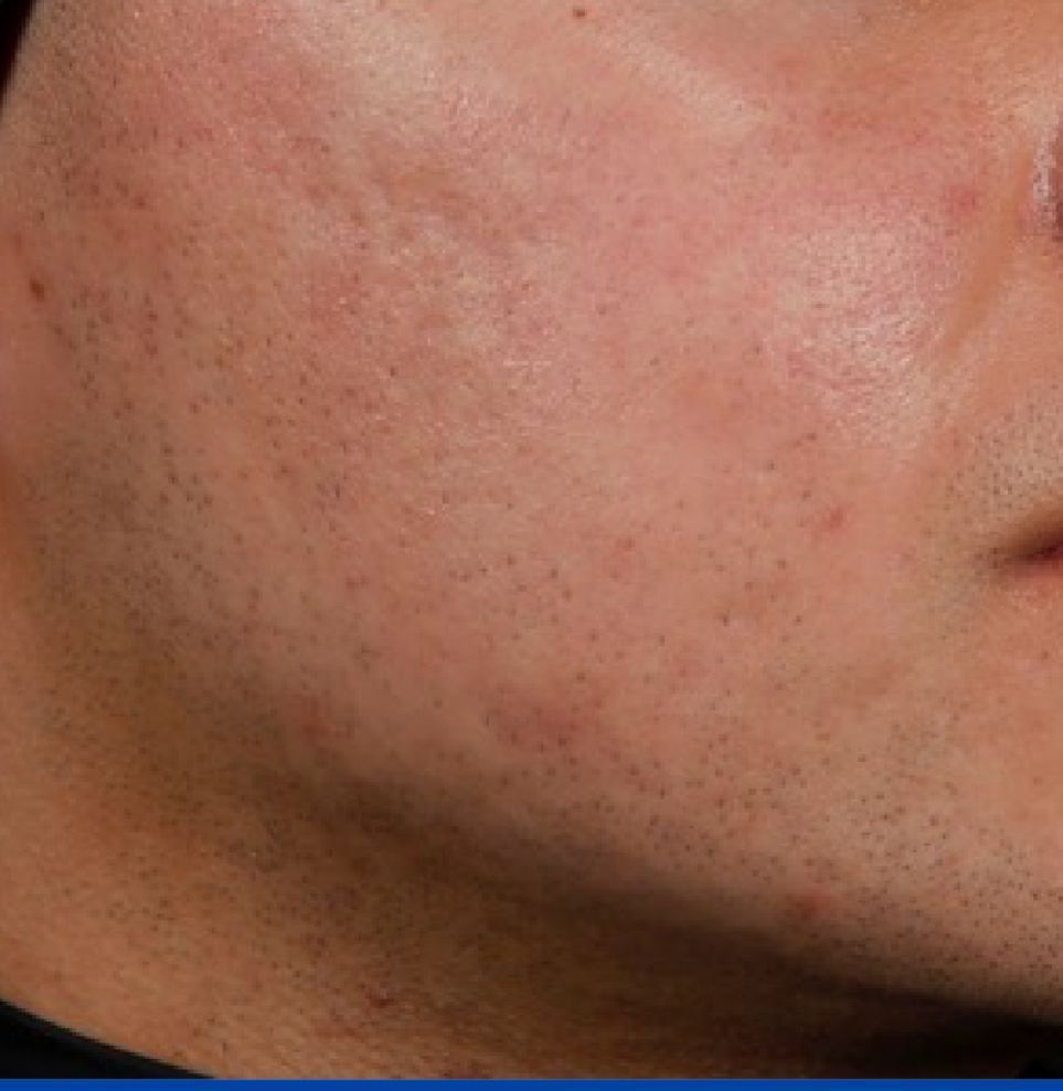 acne 6 to 12 months after