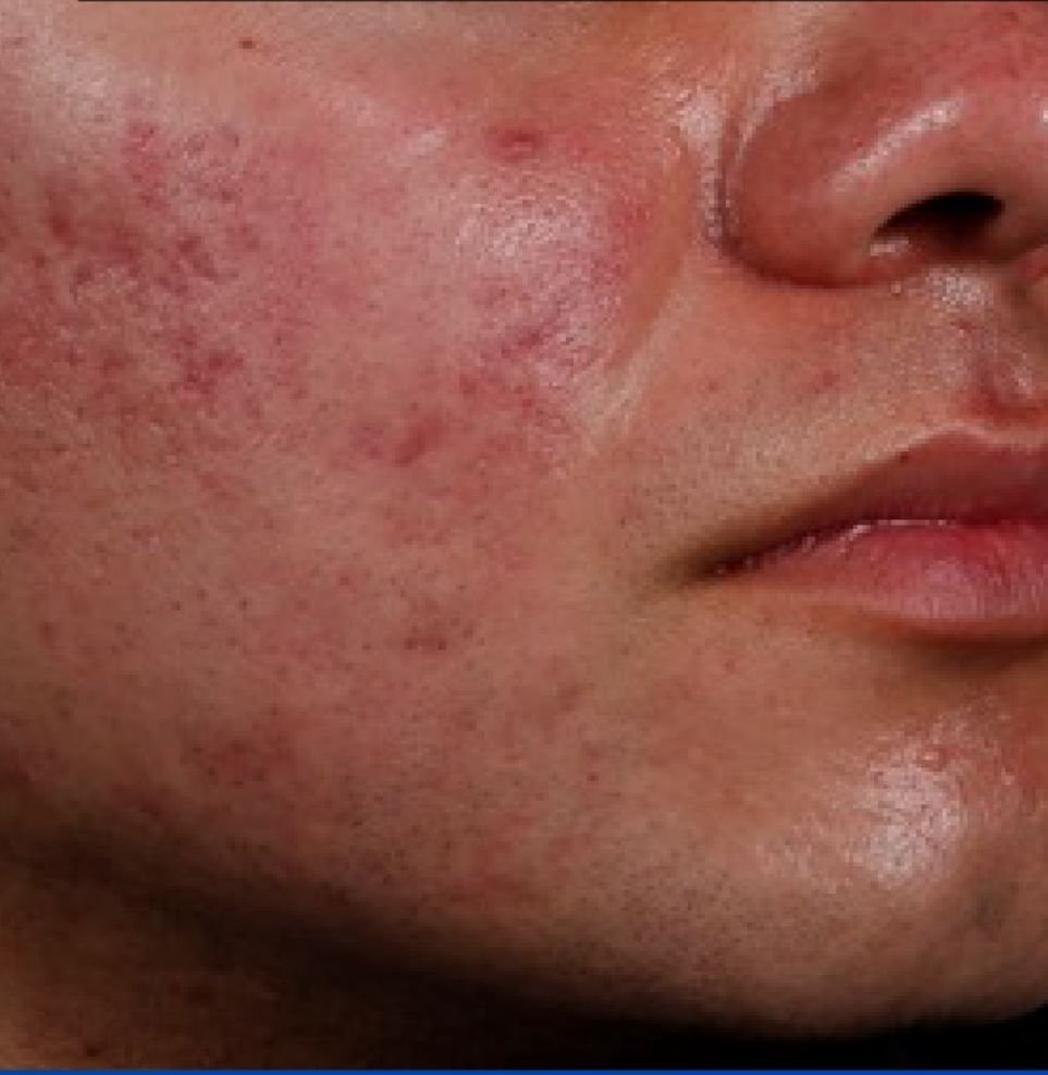 acne 6 to 12 months before.