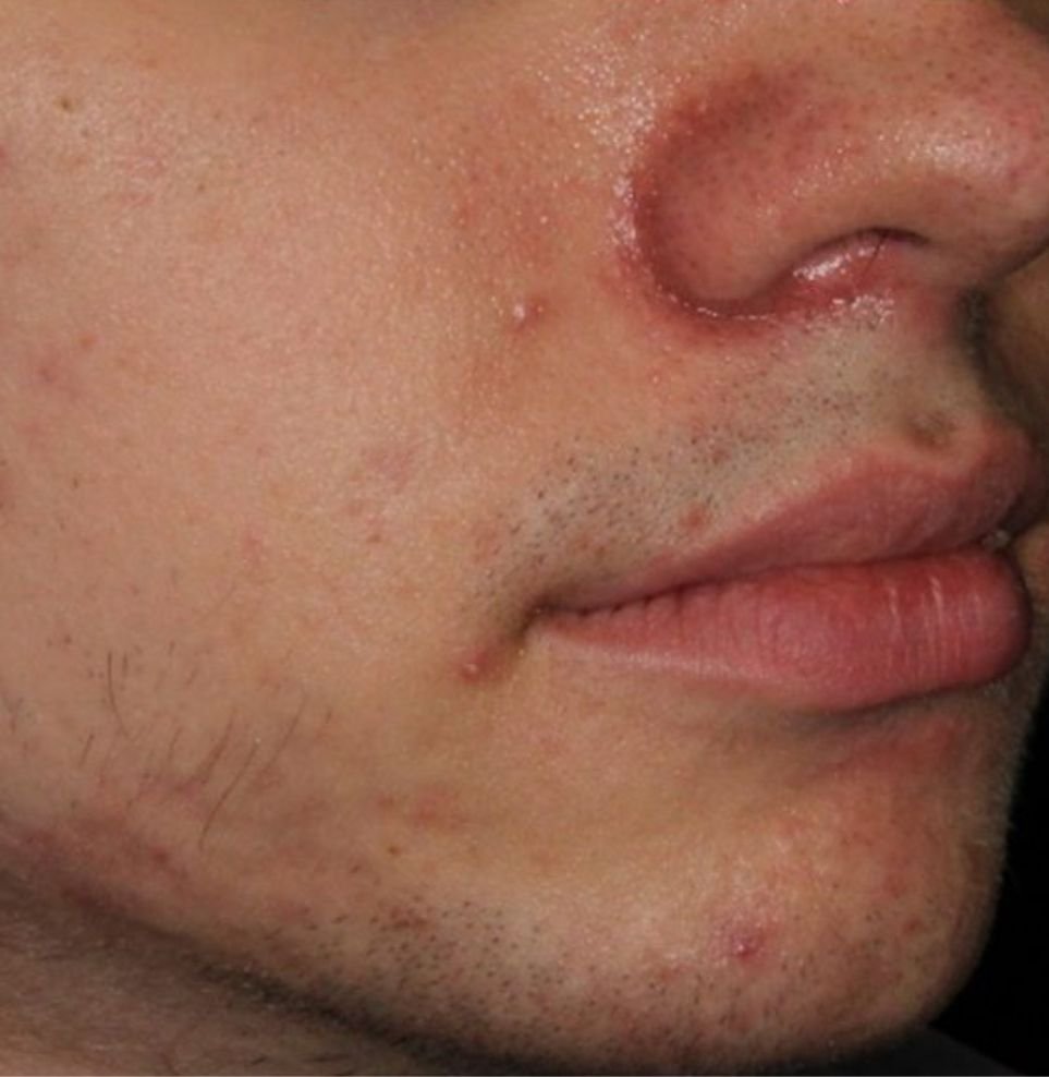 acne after treatment