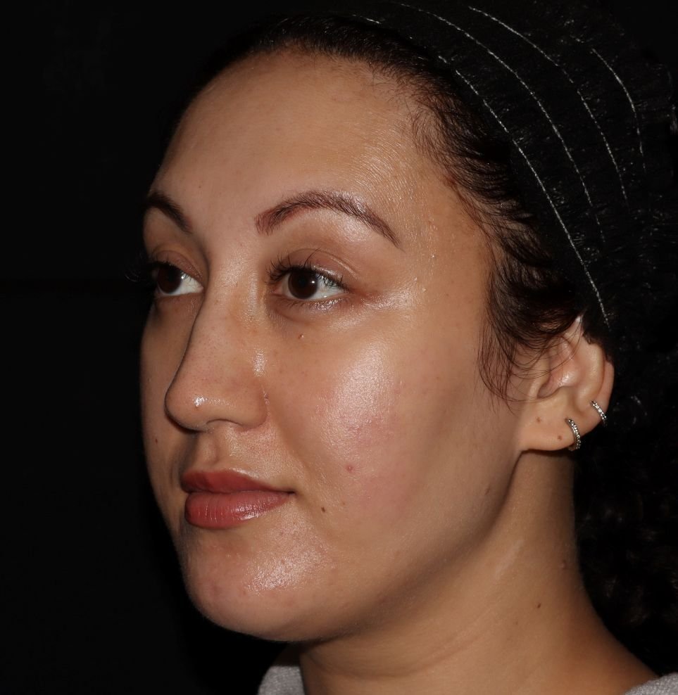 acne aviclear after