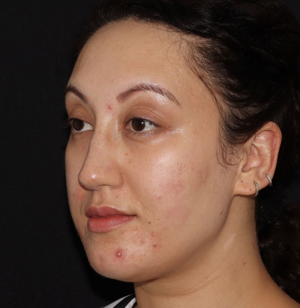 acne aviclear before