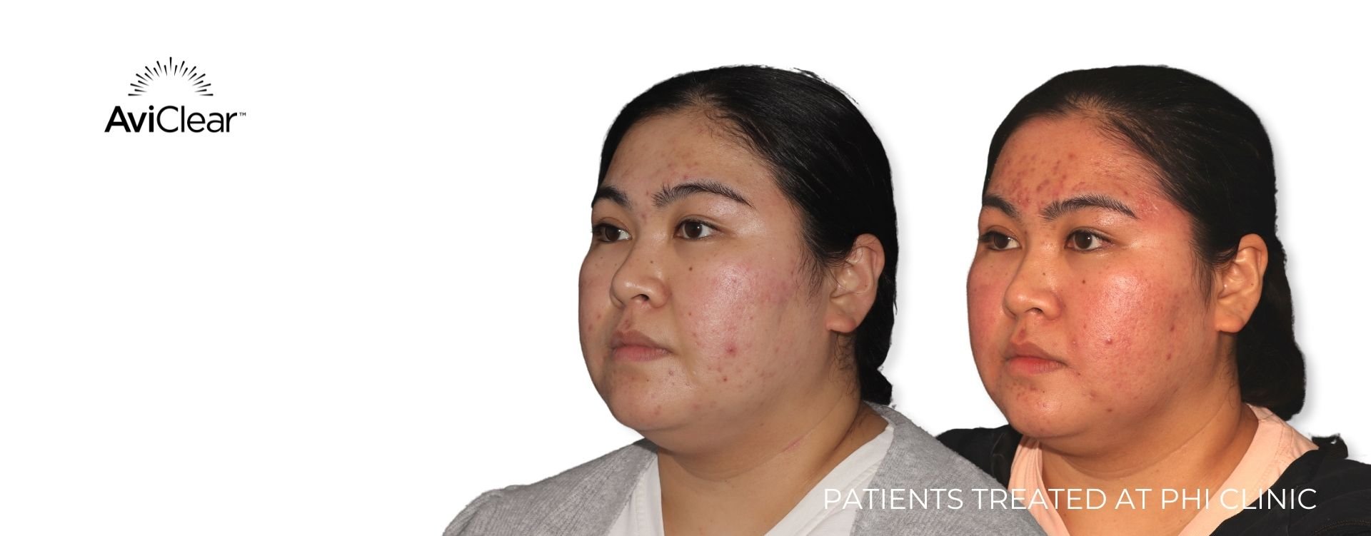 acne before and after result phi clinic london