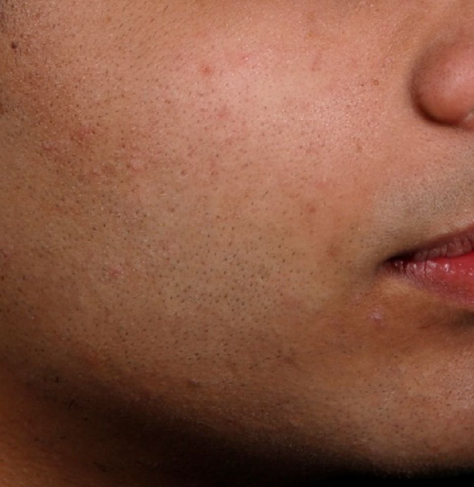 acne london 6 to 12 after