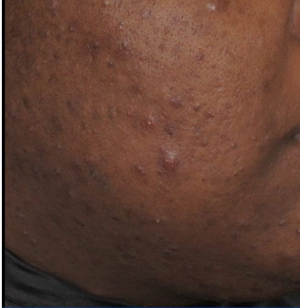 acne london before