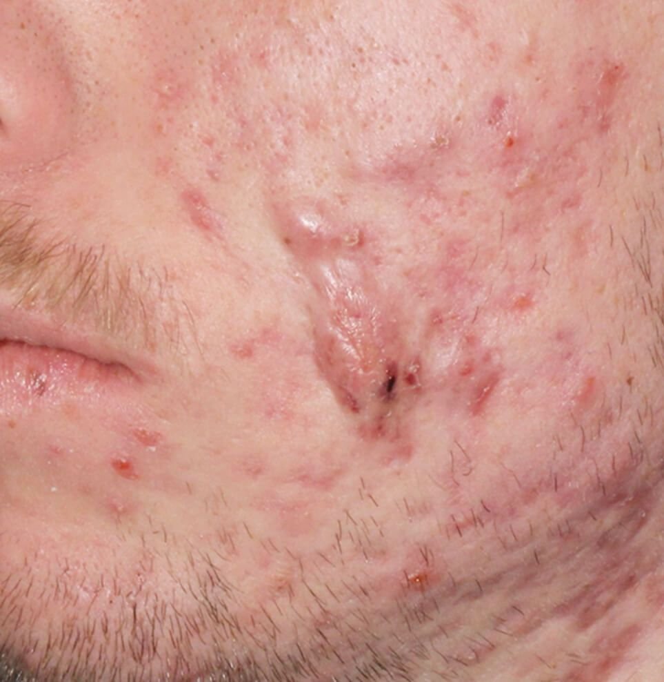 acne redness after result