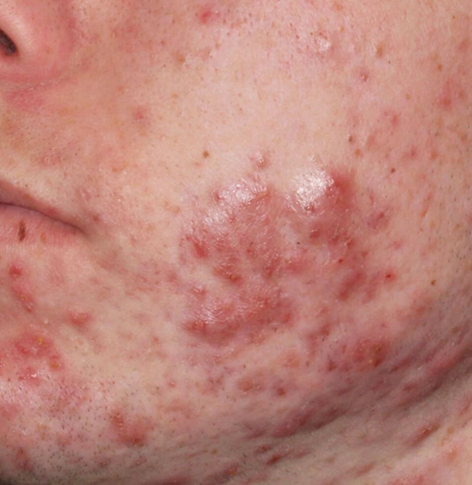 acne redness before result