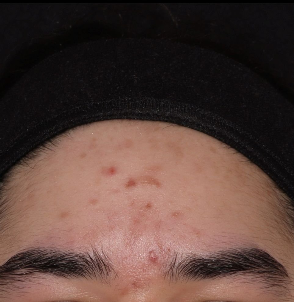 acne results after