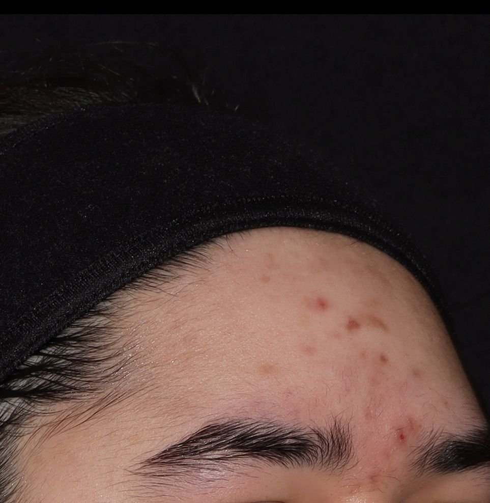 acne results after forehead