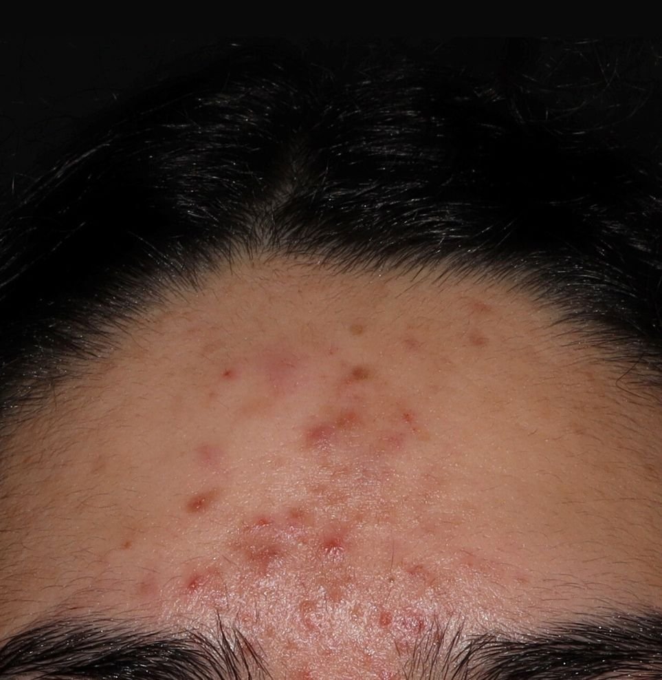 acne results before