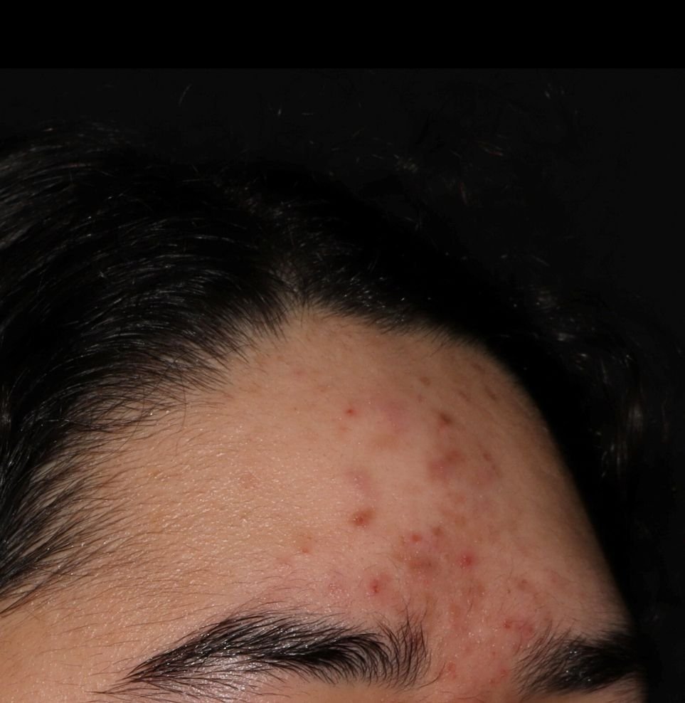 acne results before forehead