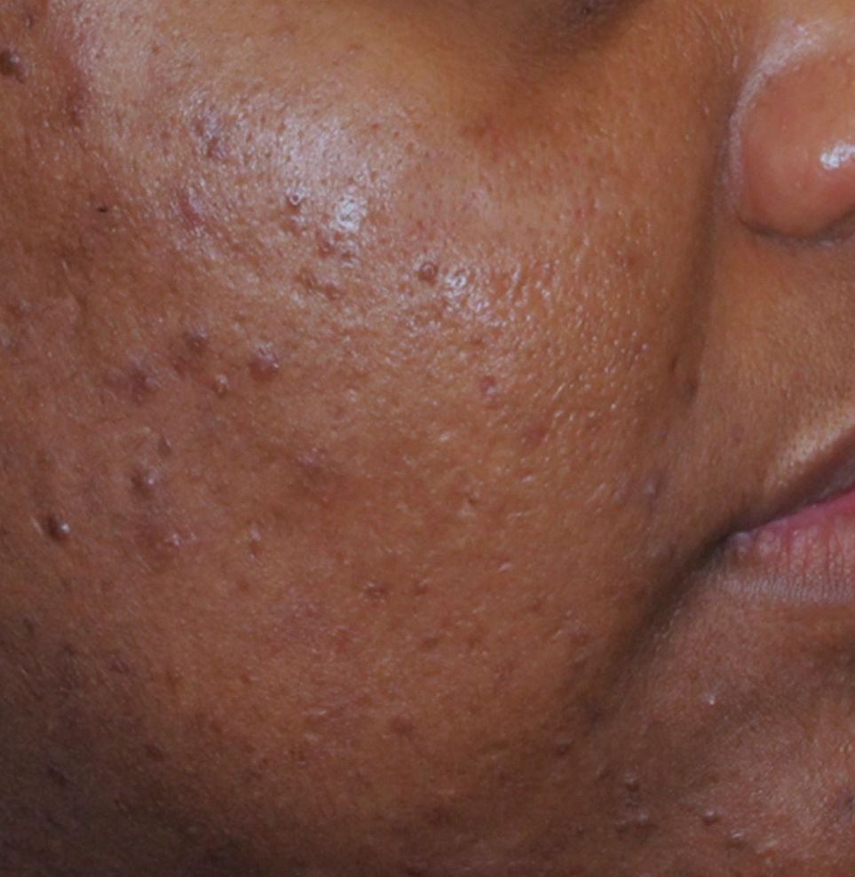 acne skin result after