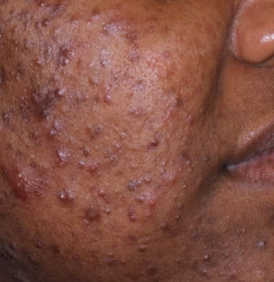acne skin result before