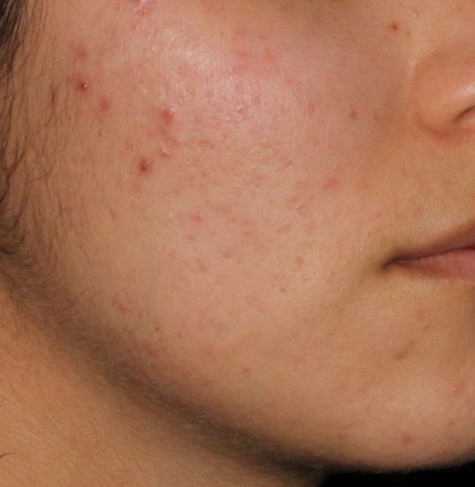 acne treatment after