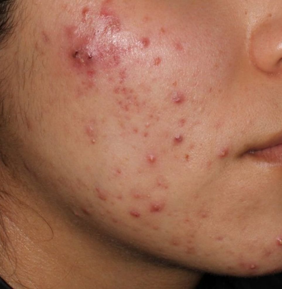 acne treatment before