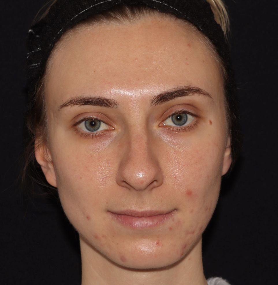 aviclear before acne london