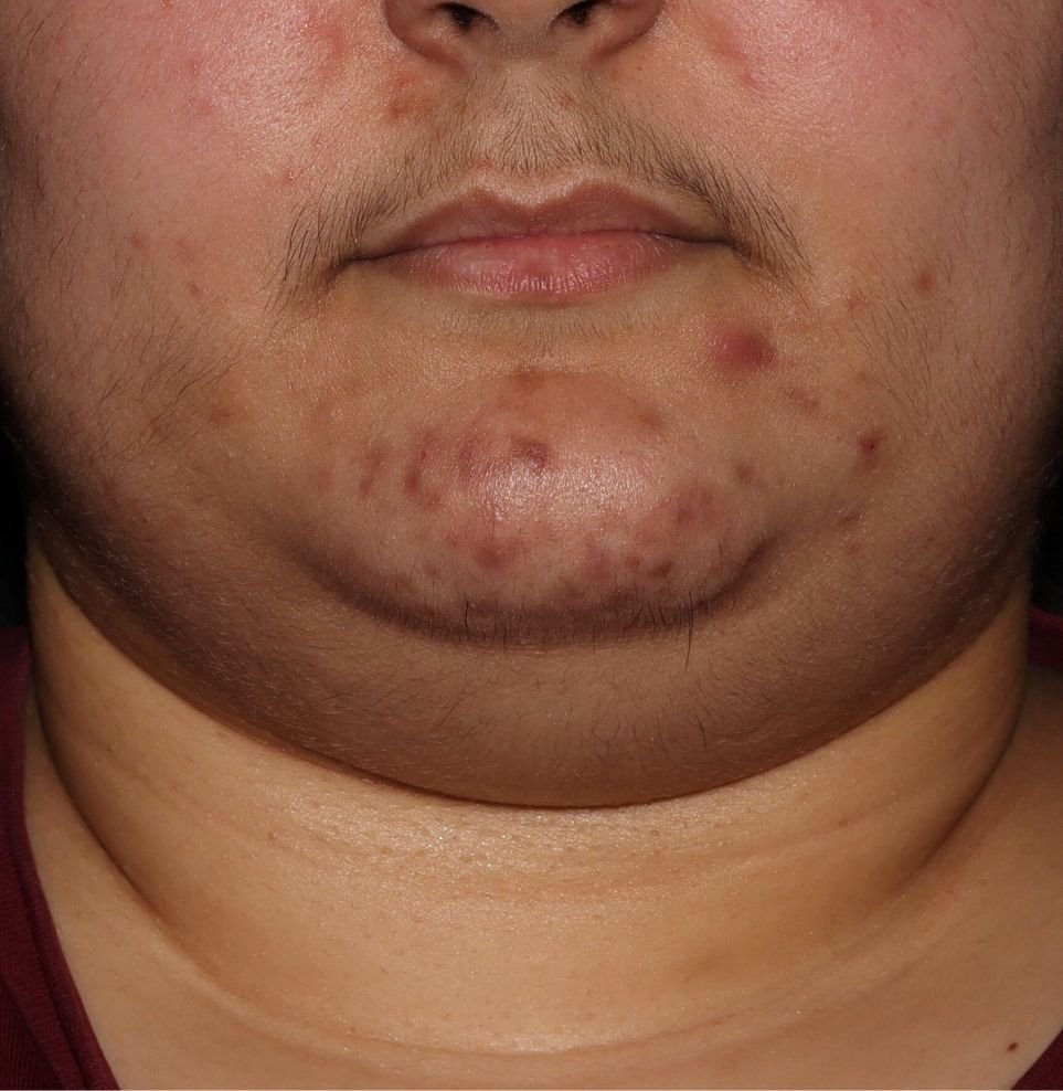best acne london treatment before chin