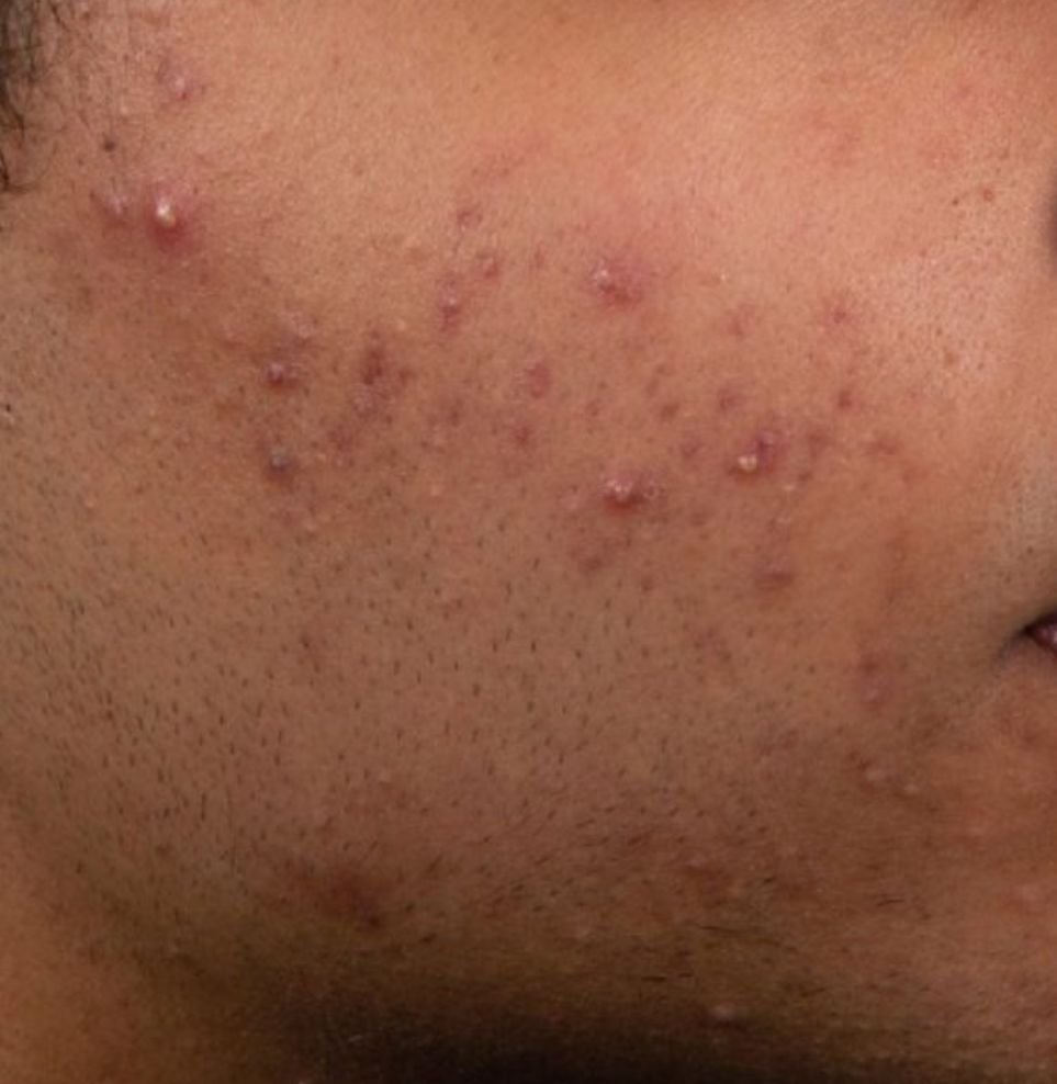 acne treatment before.jpg