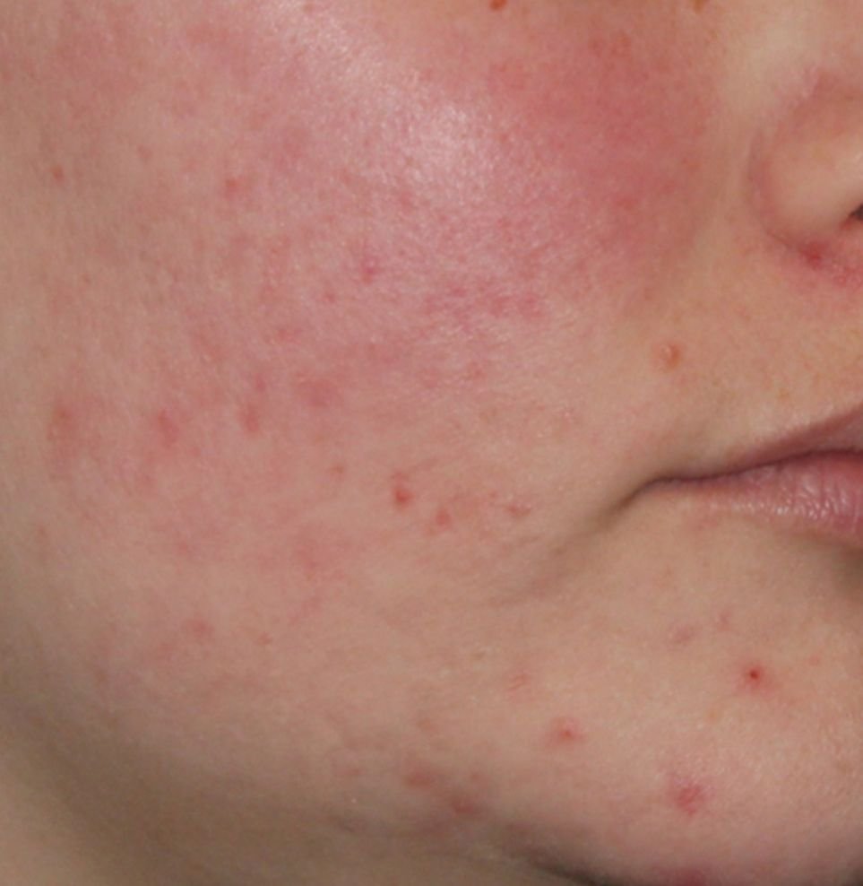 best acne treatment result after