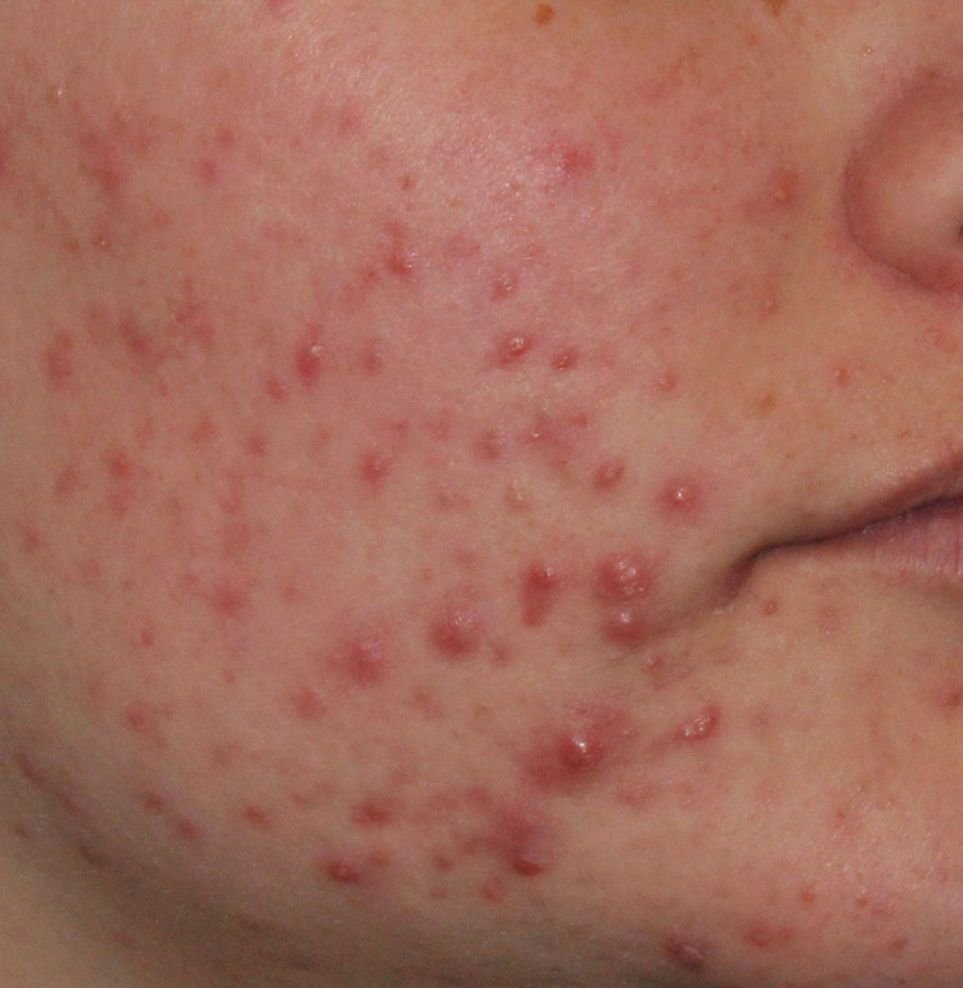 best acne treatment result before