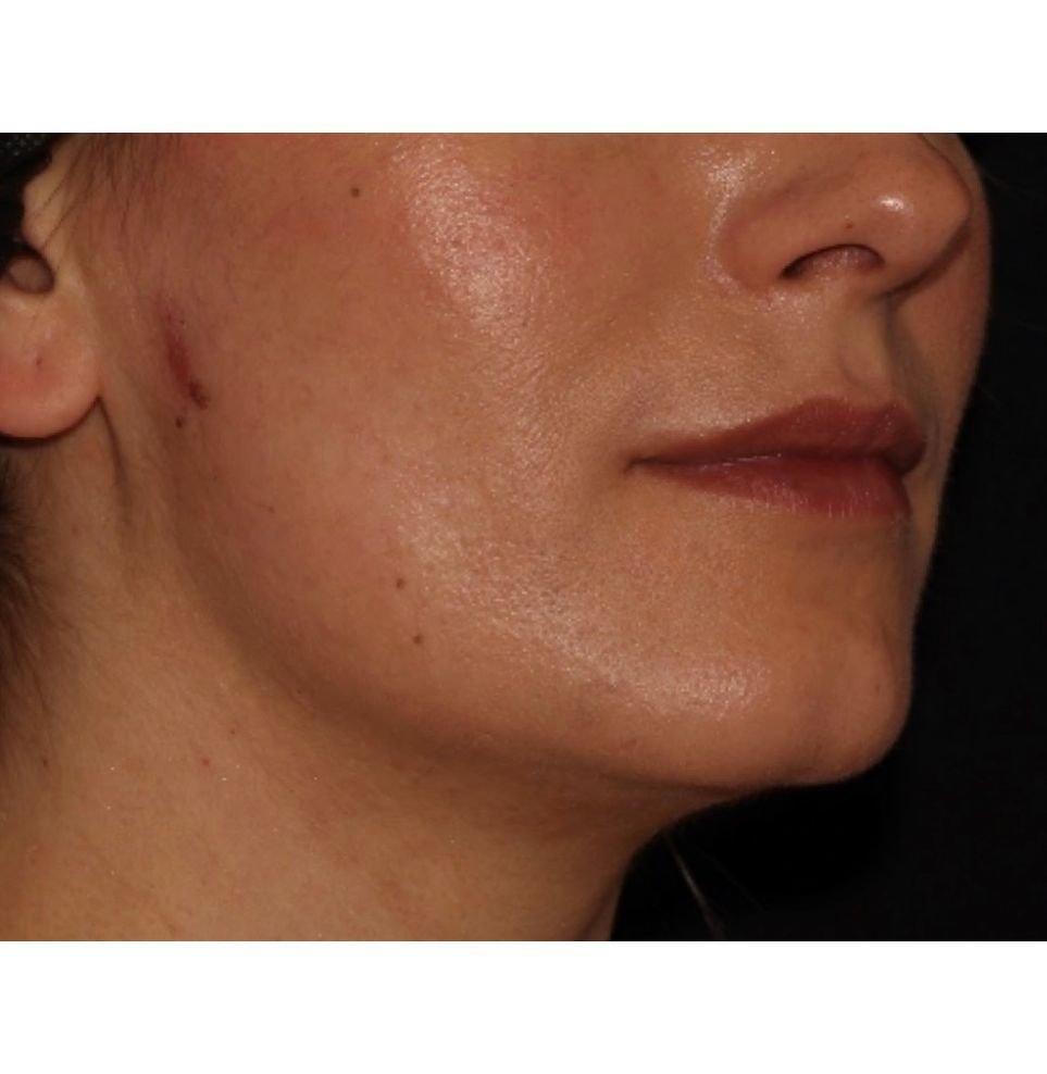 jawline chin endolift tightening results before