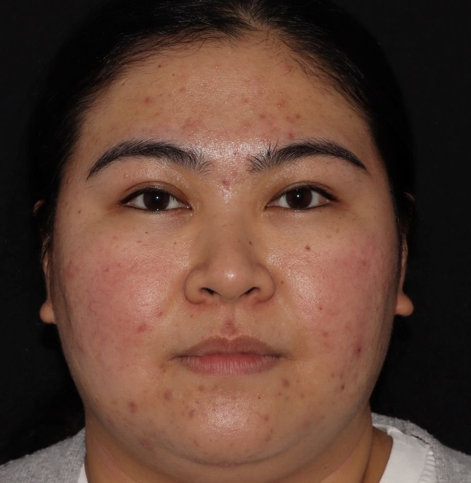 severe acne after treatment