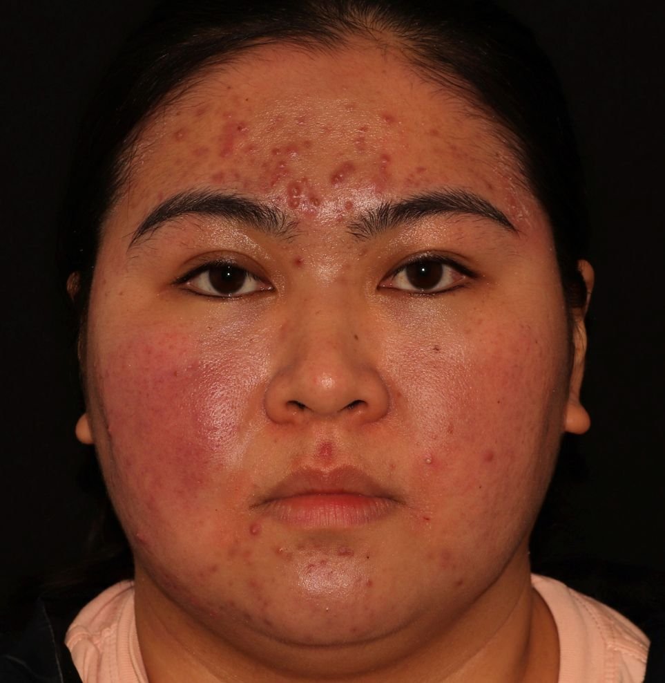 severe acne before treatment