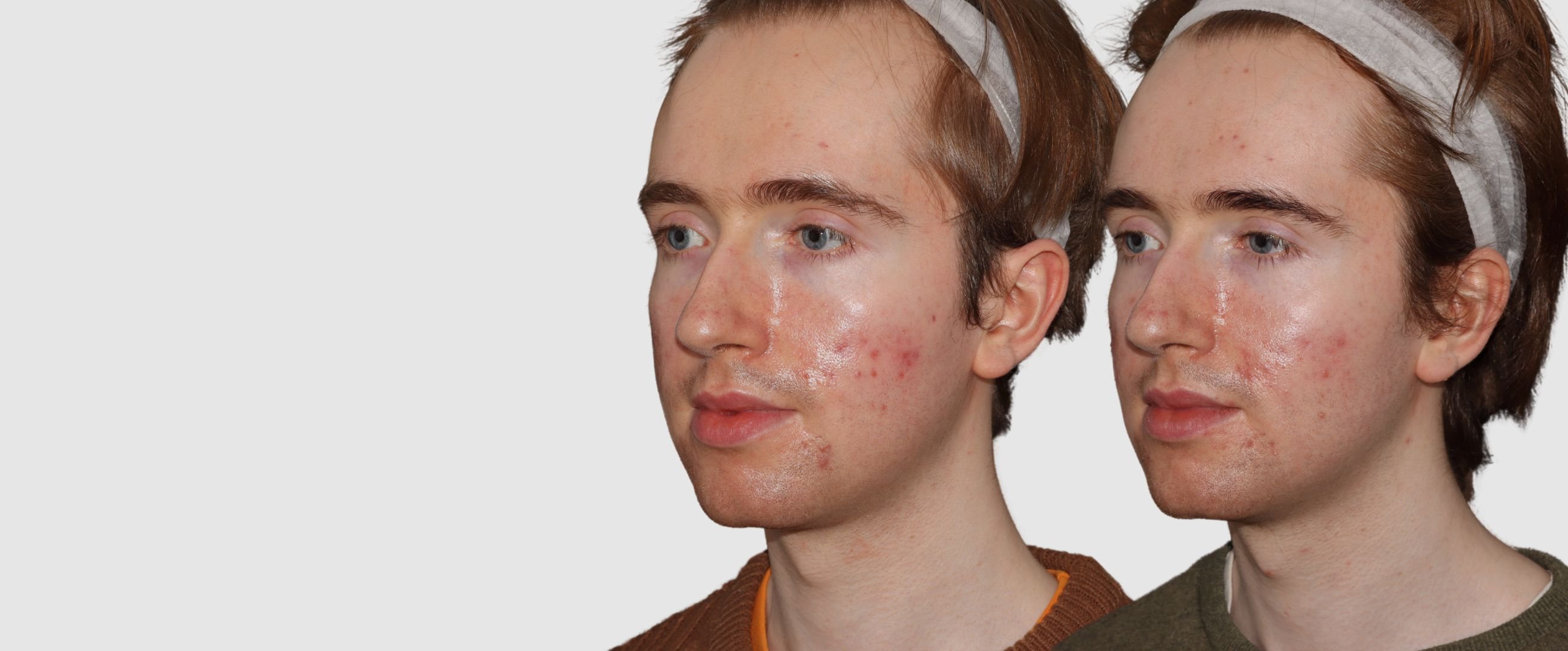 acne before after result phi clinic london