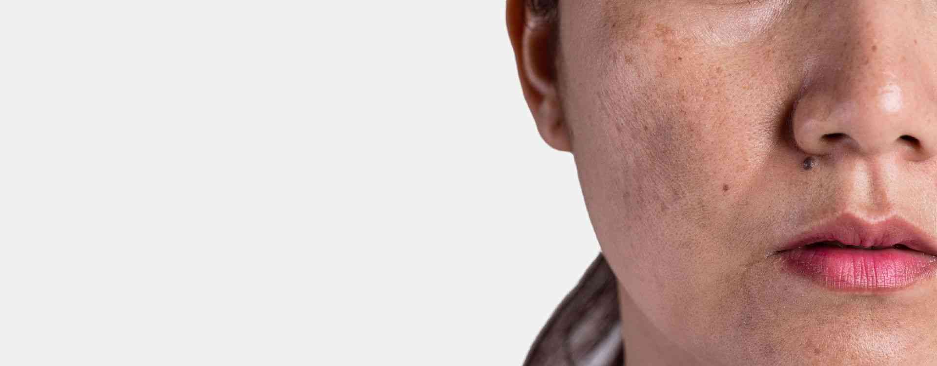 age spots pigmentation london treatment