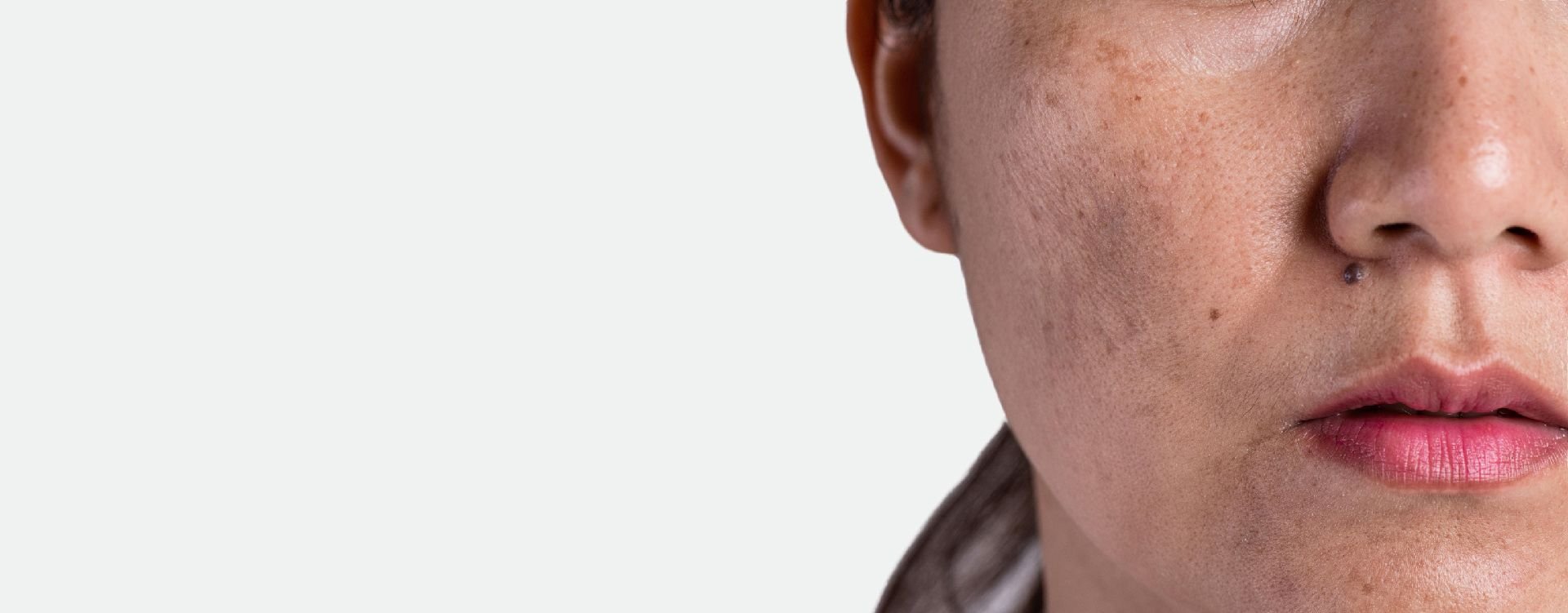 age spots pigmentation london treatment