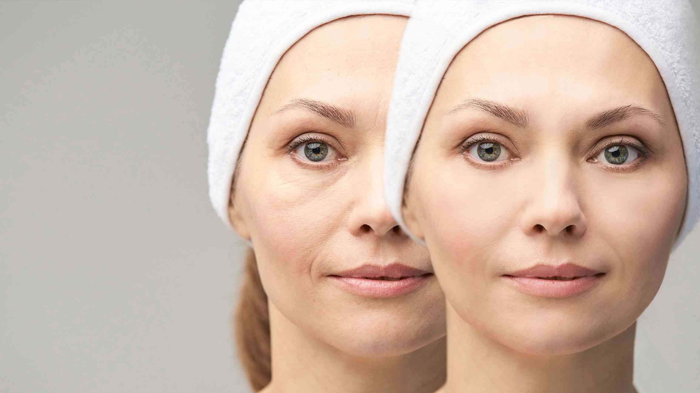 bags under eyes. treatment in london