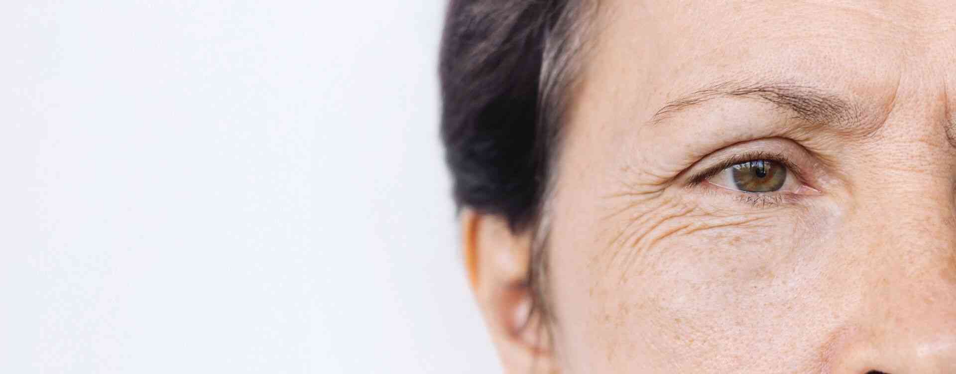 crows feet eye wrinkle botox treatment london