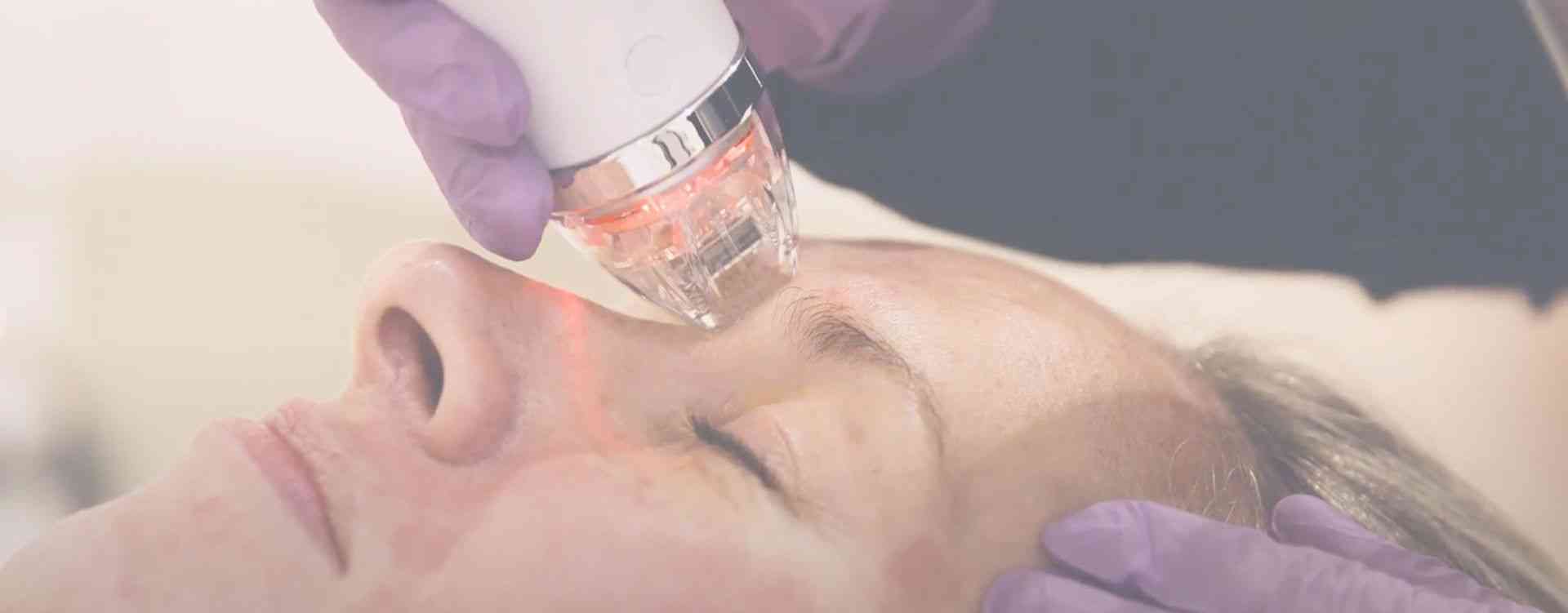 secret rf skin tightening in london clinic