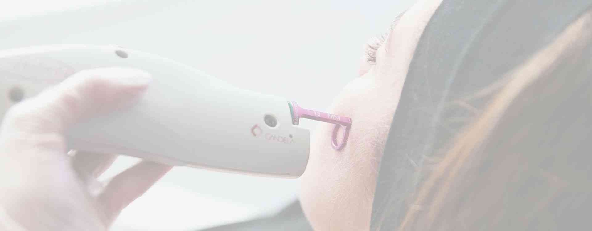 v beam damage skin treatment