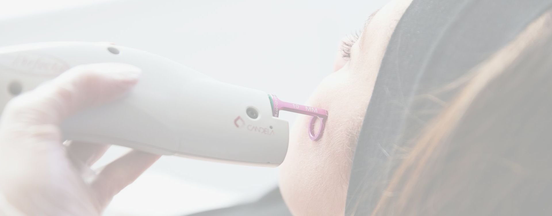 v beam damage skin treatment